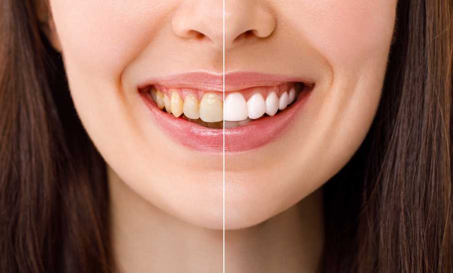 Best Teeth Whitening Kits